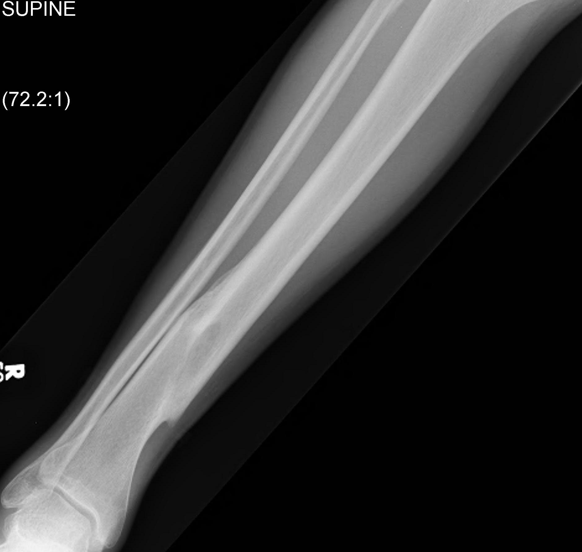 Tibial Shaft Fracture Non Operative Treatment After